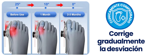 CORRECTOR DE JUANETES - Bisagra Graduable - Dile ADIÓS al DOLOR de pies 😪🦶