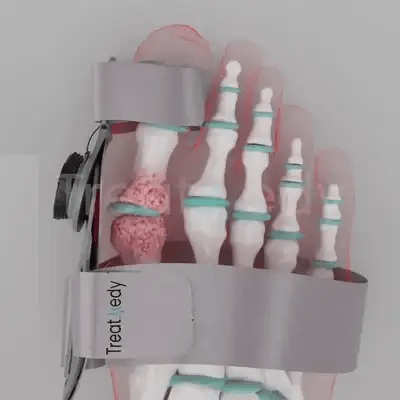 CORRECTOR DE JUANETES - Bisagra Graduable - Dile ADIÓS al DOLOR de pies 😪🦶