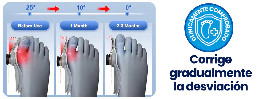CORRECTOR DE JUANETES - Bisagra Graduable - Dile ADIÓS al DOLOR de pies 😪🦶