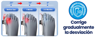 CORRECTOR DE JUANETES - Bisagra Graduable - Dile ADIÓS al DOLOR de pies 😪🦶